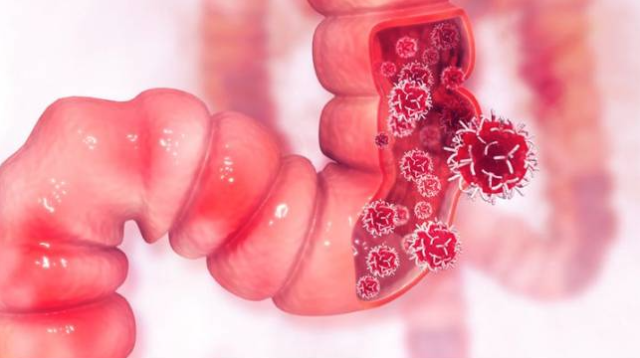 Waspadai Makanan Penyebab Kanker Usus Besar yang Harus Dihindari